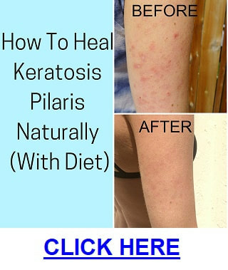 Picture of ​best treatment for keratosis pilaris on face